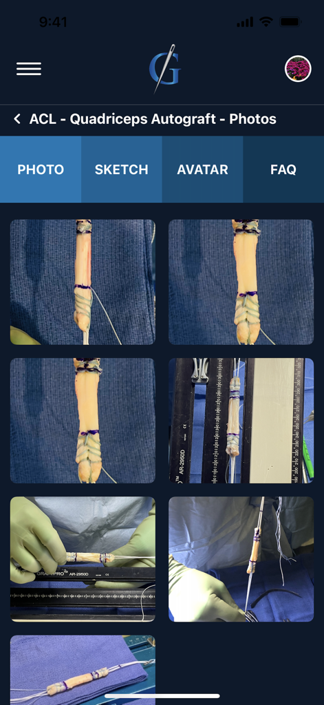 Galleria di foto cliniche di autoinnesti quadricipitali per LCA.