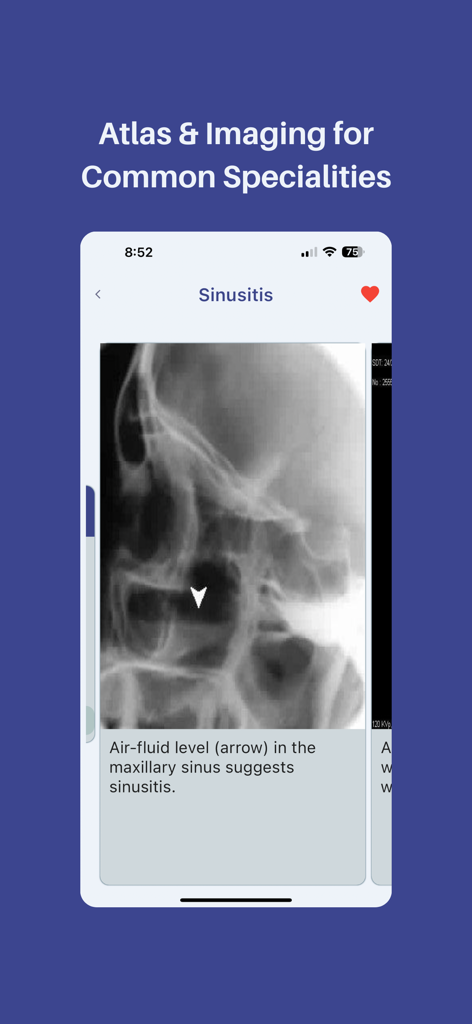 Medinfo: Medical Information - Medinfo app screenshot showing a radiology atlas for sinusitis with an X-ray image