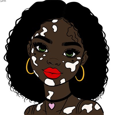 bleautiful black girl with vitiligo