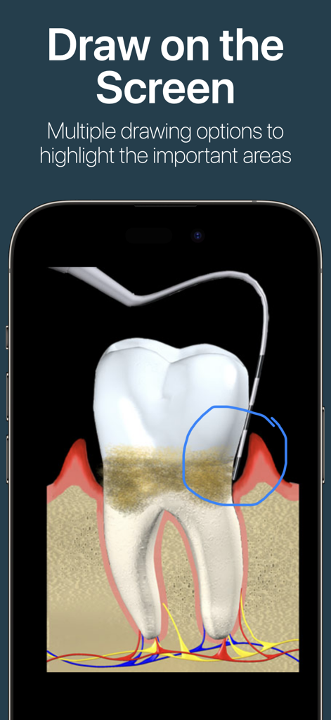 DDS GP - iPhone screen showing the DDS GP app drawing feature highlighting a tooth condition for patient education