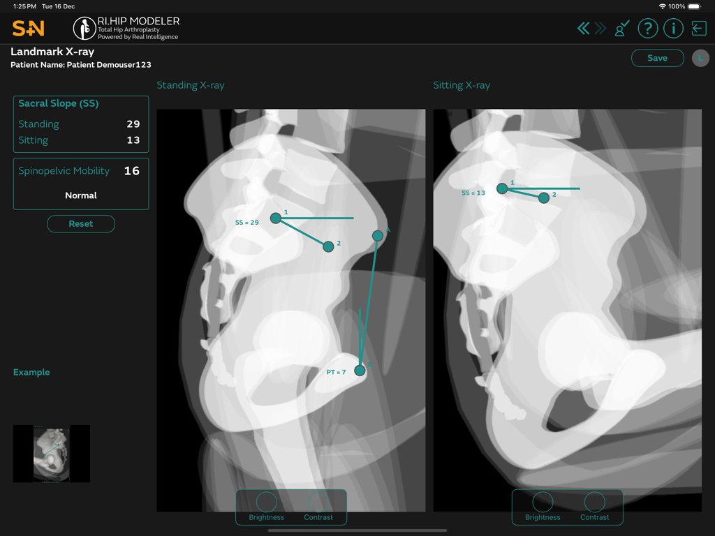 RI.HIP MODELER - Medical App | MWM