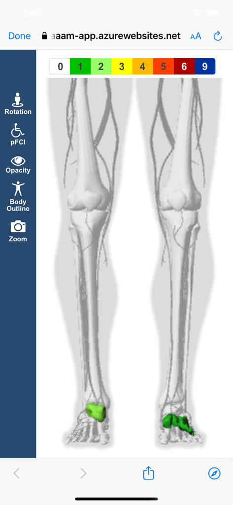 AIS Digital Dictionary - A 3D anatomical model of human legs with highlighted injury areas on the feet for medical coding