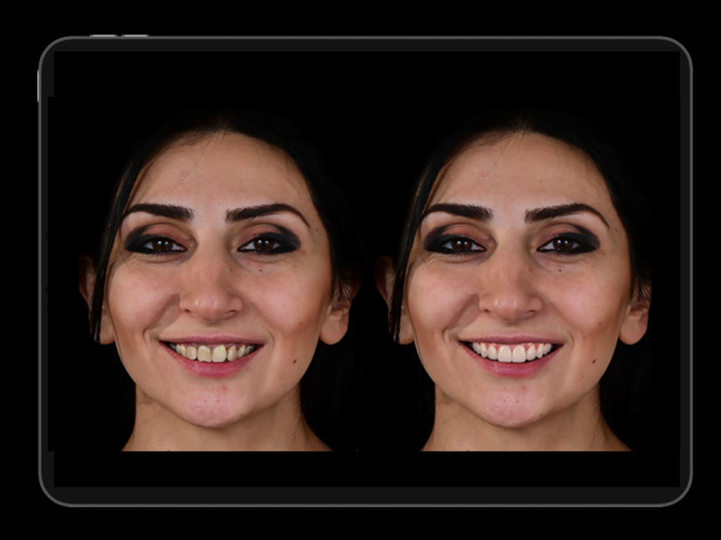Instant Smiles - 태블릿에서 전후 디지털 스마일 개선 시뮬레이션