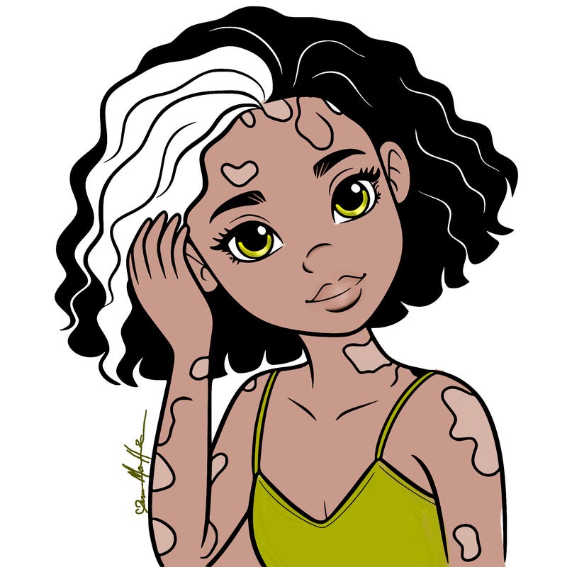 vitiligo black girl