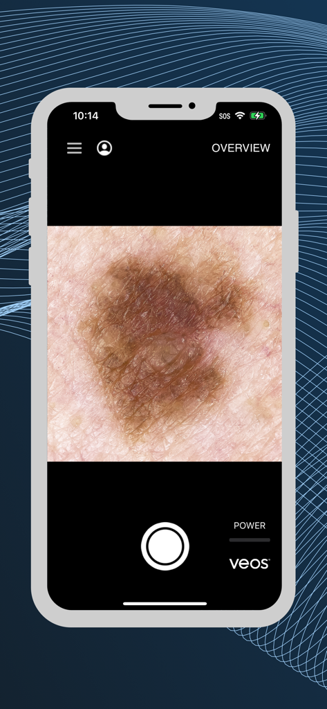 VEOS® DermaGraphix® - VEOS DermaGraphixモバイルアプリのインターフェースでの高解像度皮膚病変キャプチャ。