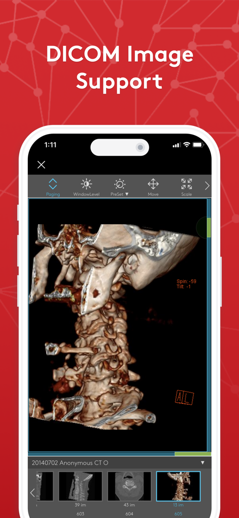Join - Medical Communication - Smartphone screen showing the Join app DICOM viewer with a 3D medical imaging scan