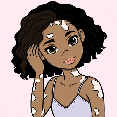 vitiligo black girl
