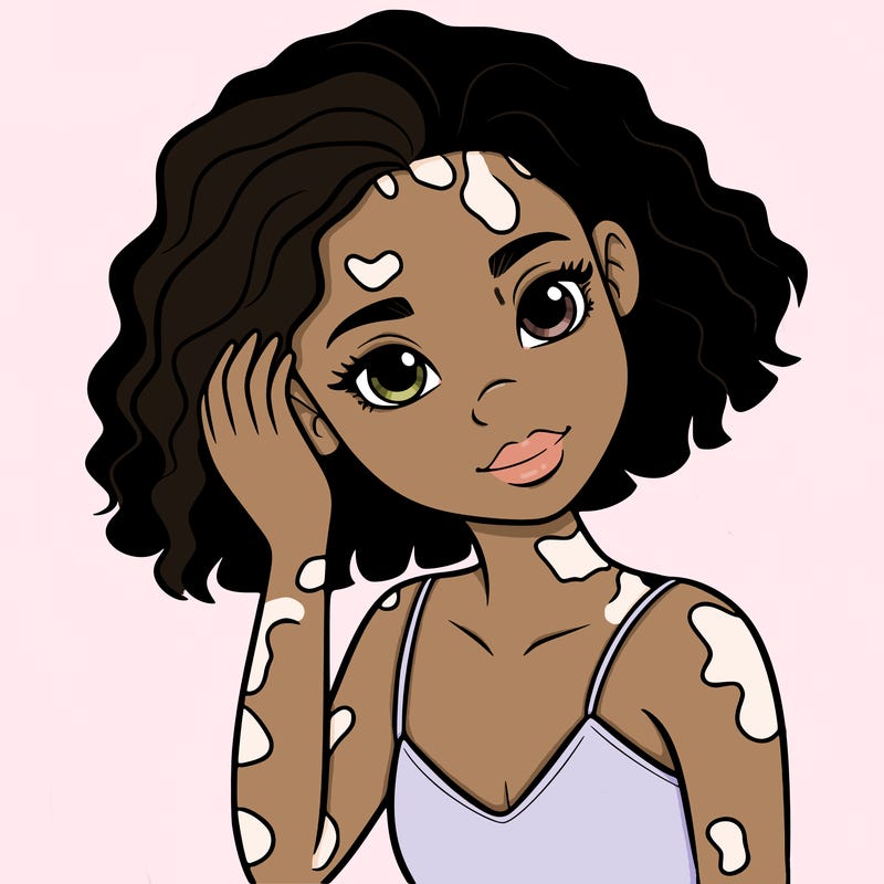 vitiligo black girl