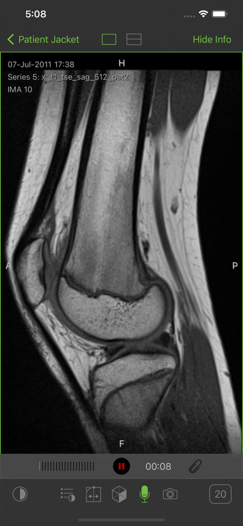 Visage Ease - A sagittal MRI scan of a knee joint displayed within the Visage Ease mobile app interface.