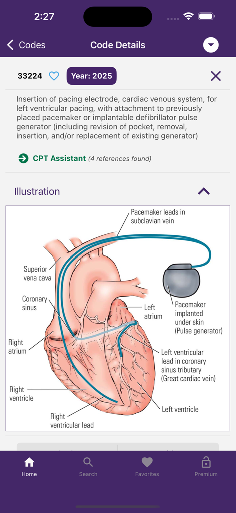 CPT QuickRef - CPT QuickRefアプリの画面。医療コード33224の詳細と心臓ペースメーカーのイラストが表示されています。