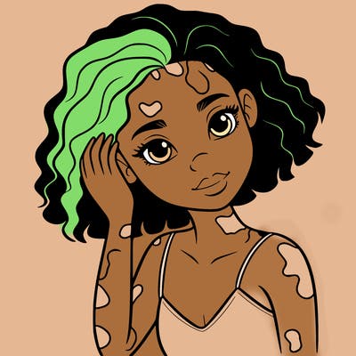 vitiligo black girl