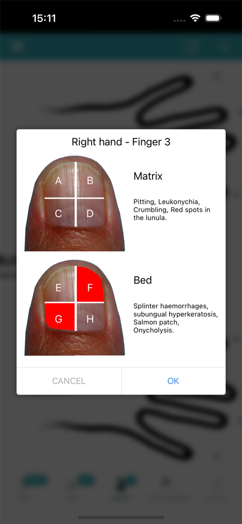 PsoriasisCalc - Calculadora del Índice de Gravedad de la Psoriasis de las Uñas NAPSI dentro de la aplicación PsoriasisCalc que muestra la evaluación de la matriz y el lecho ungueal