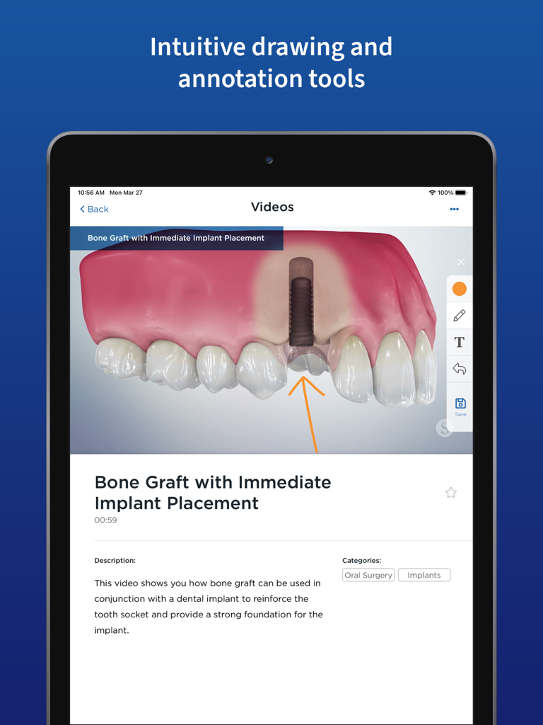 Spear Patient Education - iPad display of the Spear Patient Education app showing an annotated dental implant procedure with drawing tools.
