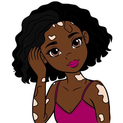 vitiligo black girl