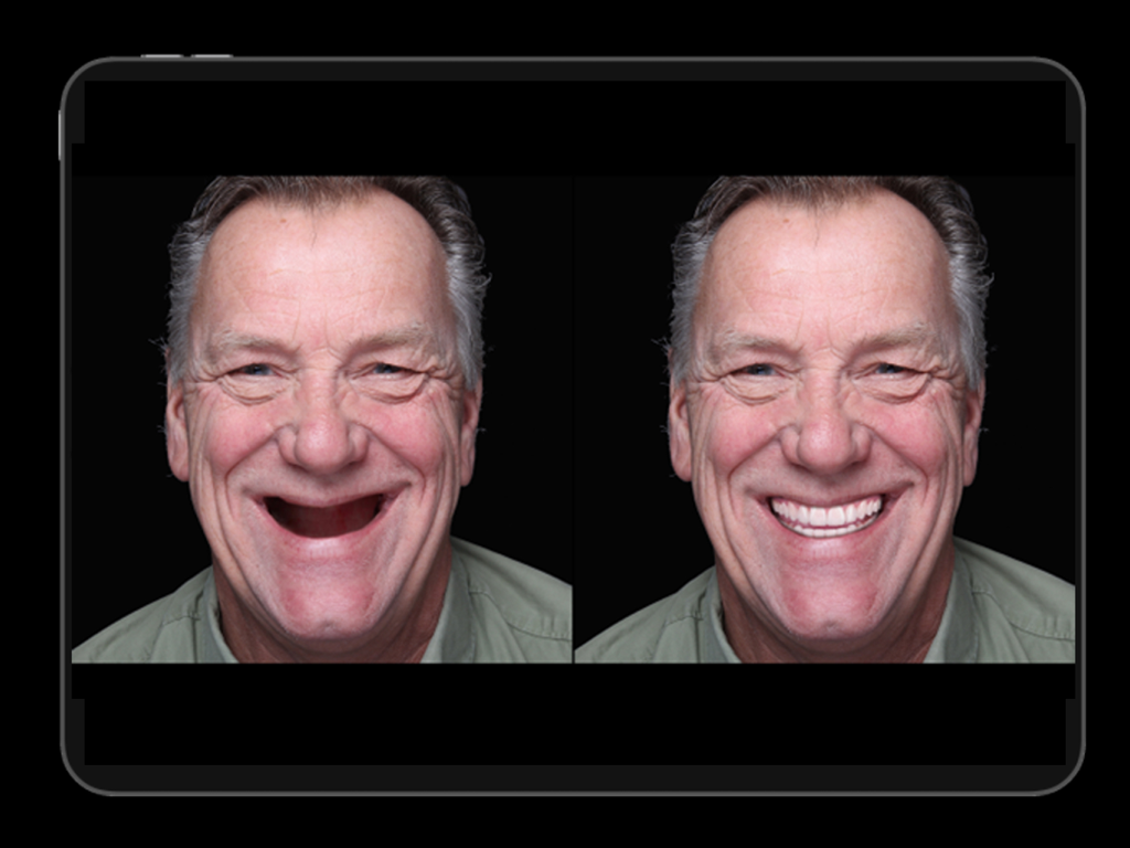 Instant Smiles - 치과 환자를 위한 측면 전후 디지털 스마일 시뮬레이션