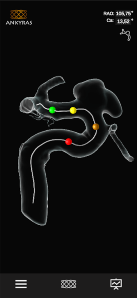 Ankyras - A 3D visualization of blood vessel morphology with interactive markers for neurosurgical planning in the Ankyras app.