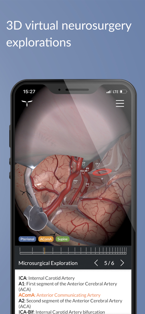 UpSurgeOn Neurosurgery - A smartphone showing a 3D virtual neurosurgery exploration with detailed brain anatomy and vascular labels.