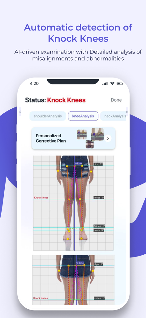 Detecção de joelhos valgos por IA na interface do aplicativo de análise de postura FlexiTrace.