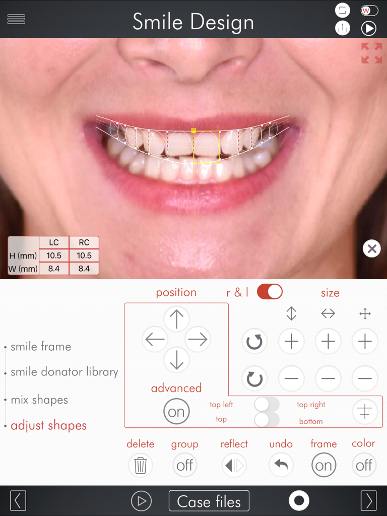 DSD App - Digital Smile Design app interface for adjusting tooth shapes and positions on a patient photo