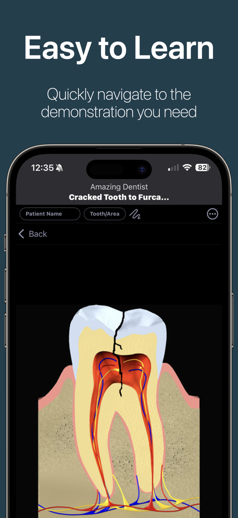 DDS GP - DDS GP app displaying a cross-section illustration of a cracked tooth for patient education on an iPhone