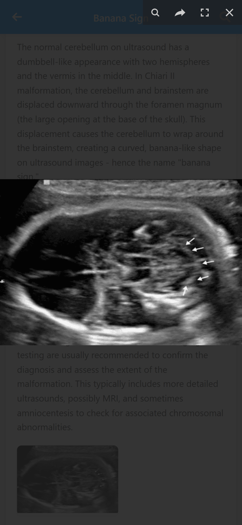 Gynecology & Obstetrics Signs - Imagen de ultrasonido médico que muestra el signo de Banana en el cerebro fetal.