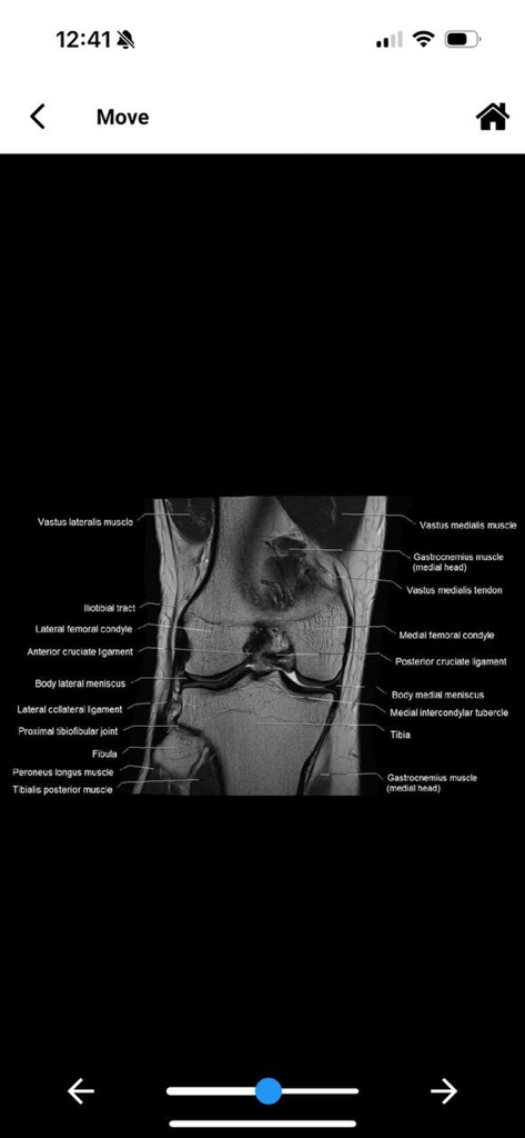 MRI MASTER - Coronal MRI scan of a knee joint with detailed anatomical labels for medical students and professionals