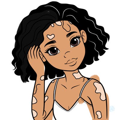 vitiligo black girl