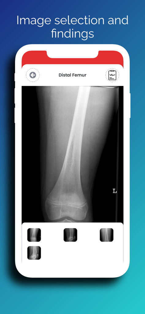 Pedbone App-Oberfläche zeigt eine pädiatrische distale Femur-Röntgenansicht mit Thumbnails zur Bildauswahl