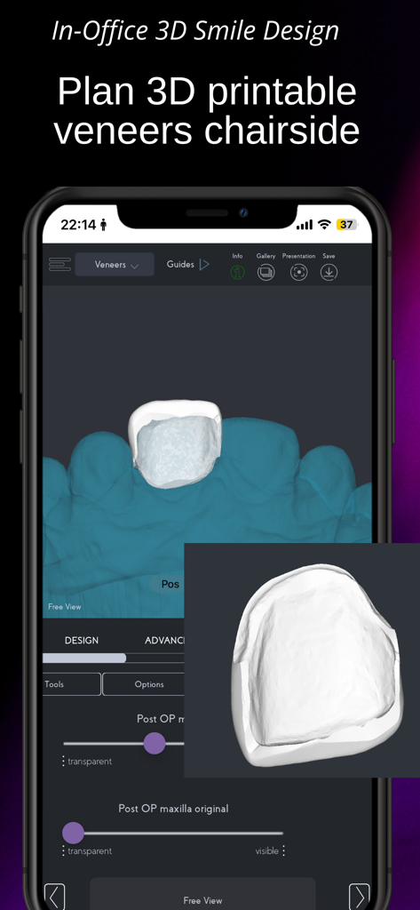 SmileFy TNG - Interfaz móvil de SmileFy TNG que muestra el diseño de carillas dentales 3D para planificación de tratamientos.