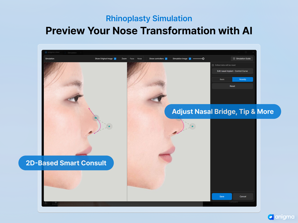 Anigma View - AI rhinoplasty simulation and nose transformation preview in the Anigma View medical app