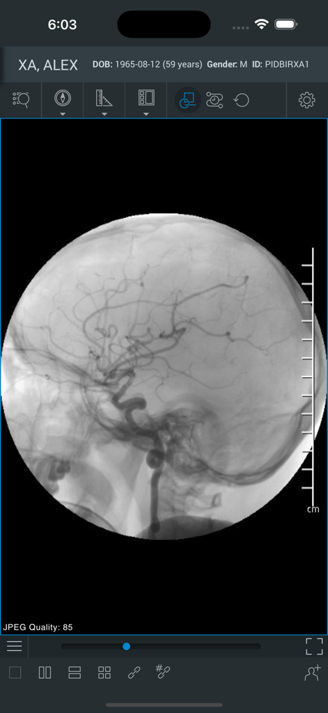 ResolutionMD - ResolutionMD app interface displaying a cerebral angiogram scan for medical diagnosis