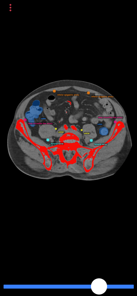 Sección transversal de escaneo TC en la aplicación Guía de Biopsia con estructuras anatómicas etiquetadas como el colon y las arterias