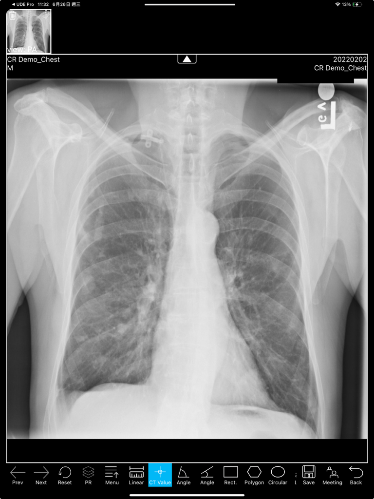 Chest X-ray displayed in the UDE Lite medical imaging app with diagnostic tool menu on an iPad