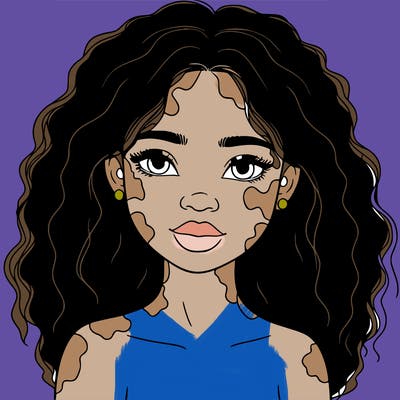 beautiful black girl with vitiligo