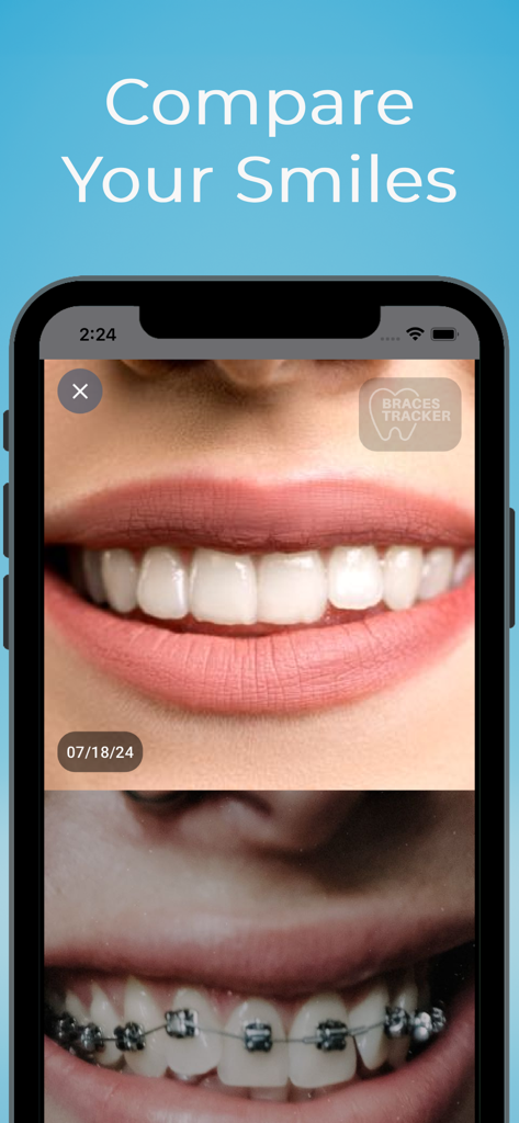 Braces Tracker - Comparison of teeth photos showing orthodontic progress in the Braces Tracker app