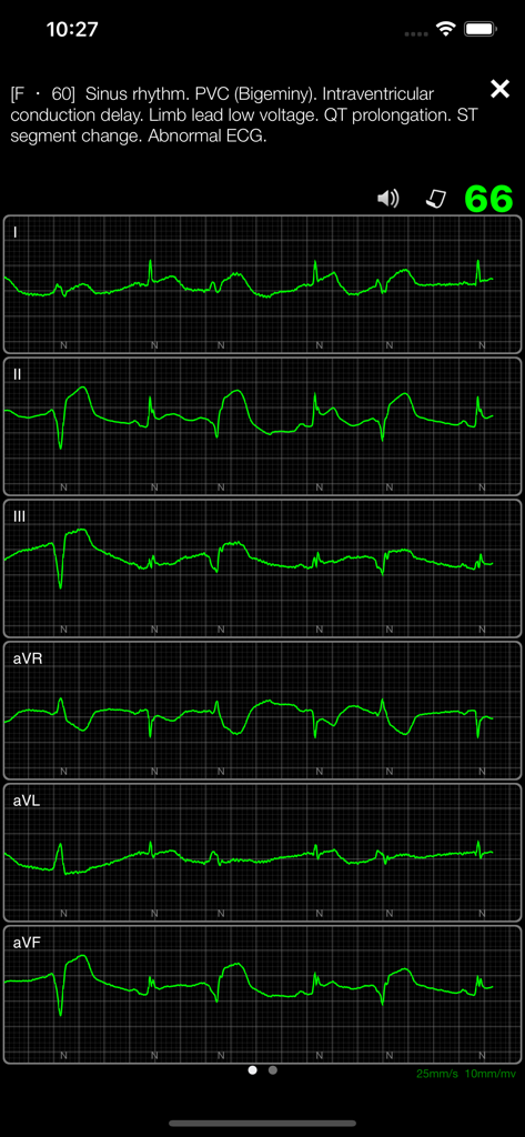 ECG Books Pro - Detailed ECG interpretation showing sinus rhythm and PVC bigeminy leads in the ECG Books Pro medical app