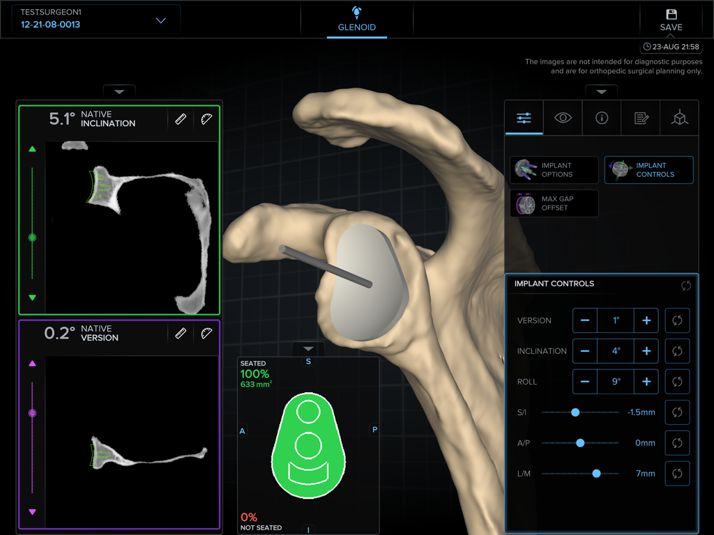 3D preoperative planning interface showing shoulder scapula with implant and adjustment controls for orthopedic surgery