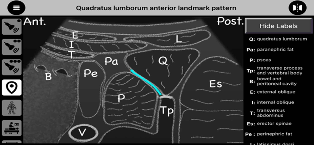 AnSo Pro - Esboço de marco anatômico do padrão anterior do quadrado lombar com rótulos clínicos