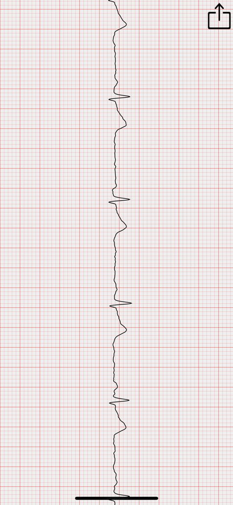 Una forma de onda detallada de ECG vertical mostrada en un fondo de cuadrícula roja estándar dentro de la aplicación móvil Checkmee Advance.