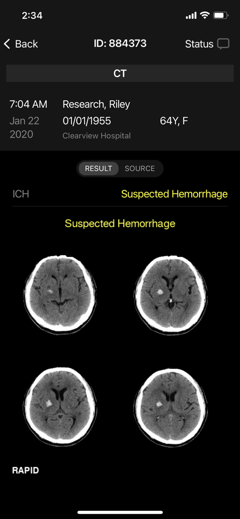 RapidAI mobile interface showing a brain CT scan with a suspected hemorrhage clinical alert