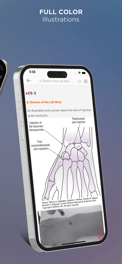 Full color anatomical illustration of wrist injection sites in the CMDT medical app