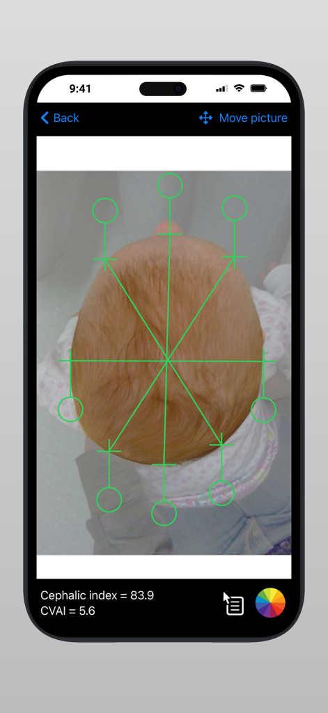 Scodiac2 - Interfaccia dell'app Scodiac2 che mostra le misurazioni dell'indice cefalico e del CVAI sulla testa di un neonato