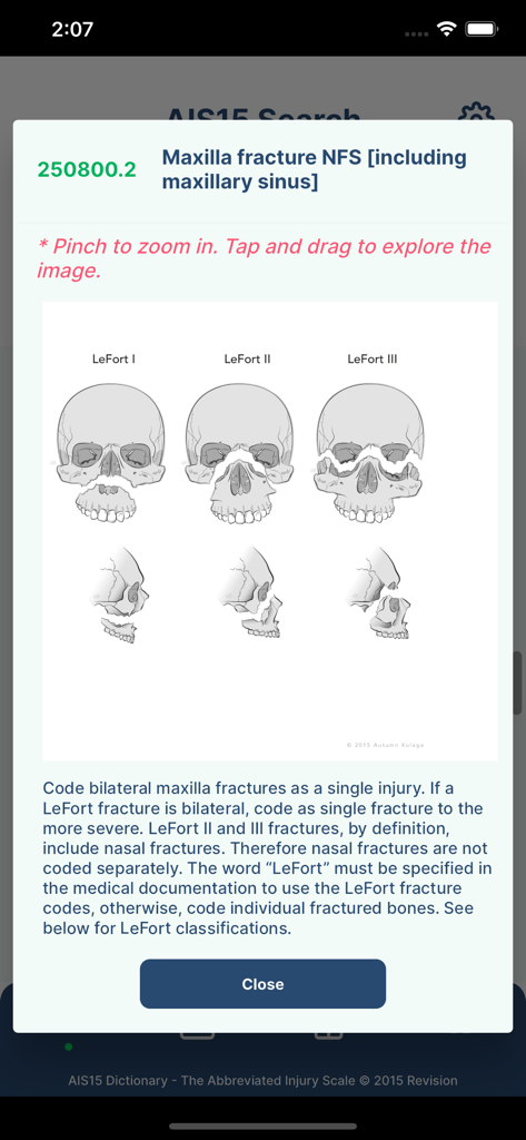 AIS Digital Dictionary - Diagram showing LeFort one two and three facial fracture classifications with medical coding instructions for maxilla fractures