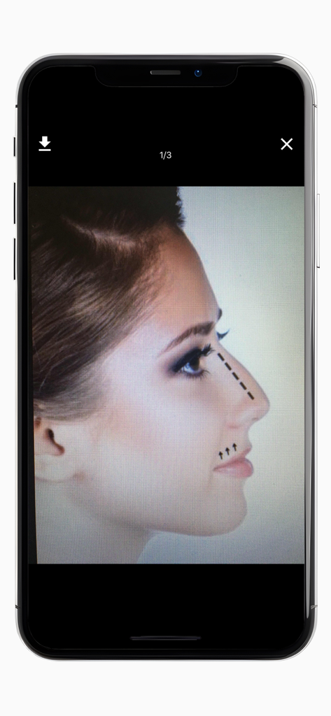 Rhino Smart - Digital rhinoplasty procedure sheet showing surgical markings on a female profile