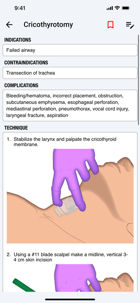 palmEM AI: EM Quick Reference - Clinical procedure guide for a cricothyrotomy within the palmEM AI medical app