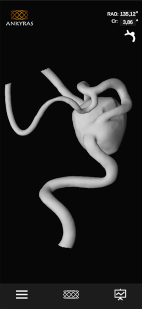 Ankyras - A 3D anatomical model showing vessel morphology and an intracranial aneurysm for medical planning in the Ankyras app