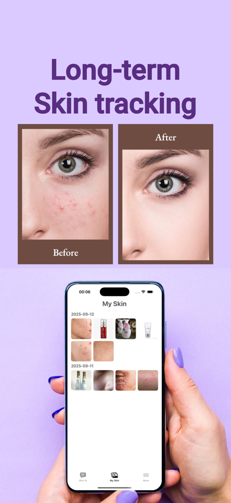 Skin AI - Best AI Skin Expert - La aplicación Skin AI mostrando seguimiento a largo plazo y fotos de comparación de piel antes y después.