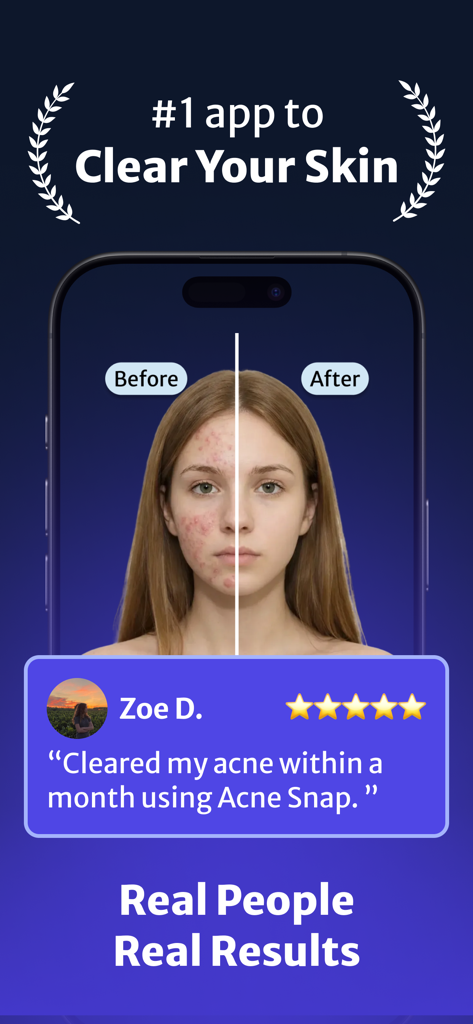 Acne Snap app screen showing a split before and after face comparison with a five star testimonial from a real user