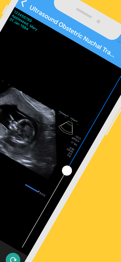 IOP Patient Portal - Smartphone display showing an ultrasound scan in the IOP Patient Portal app