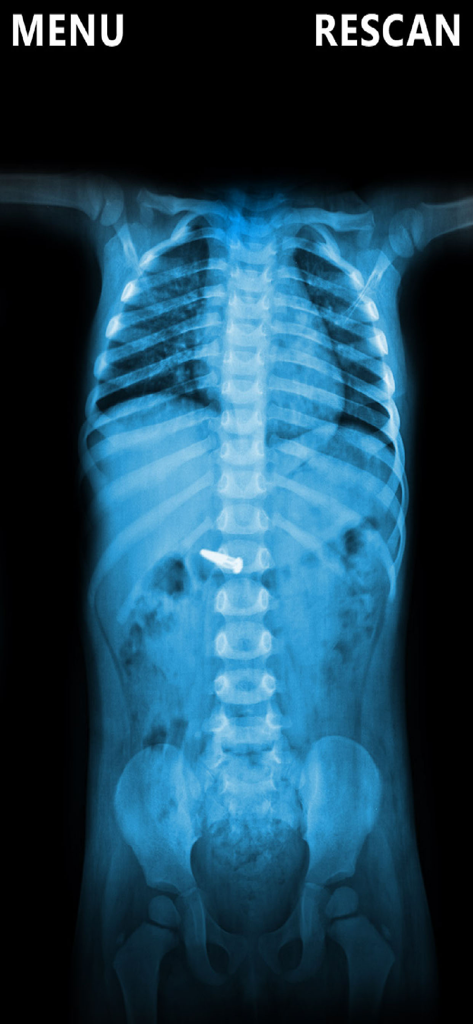X-Ray Scanner Body Prank - Un escaneo de rayos X de broma azul de un torso humano que muestra un tornillo metálico en la zona del estómago